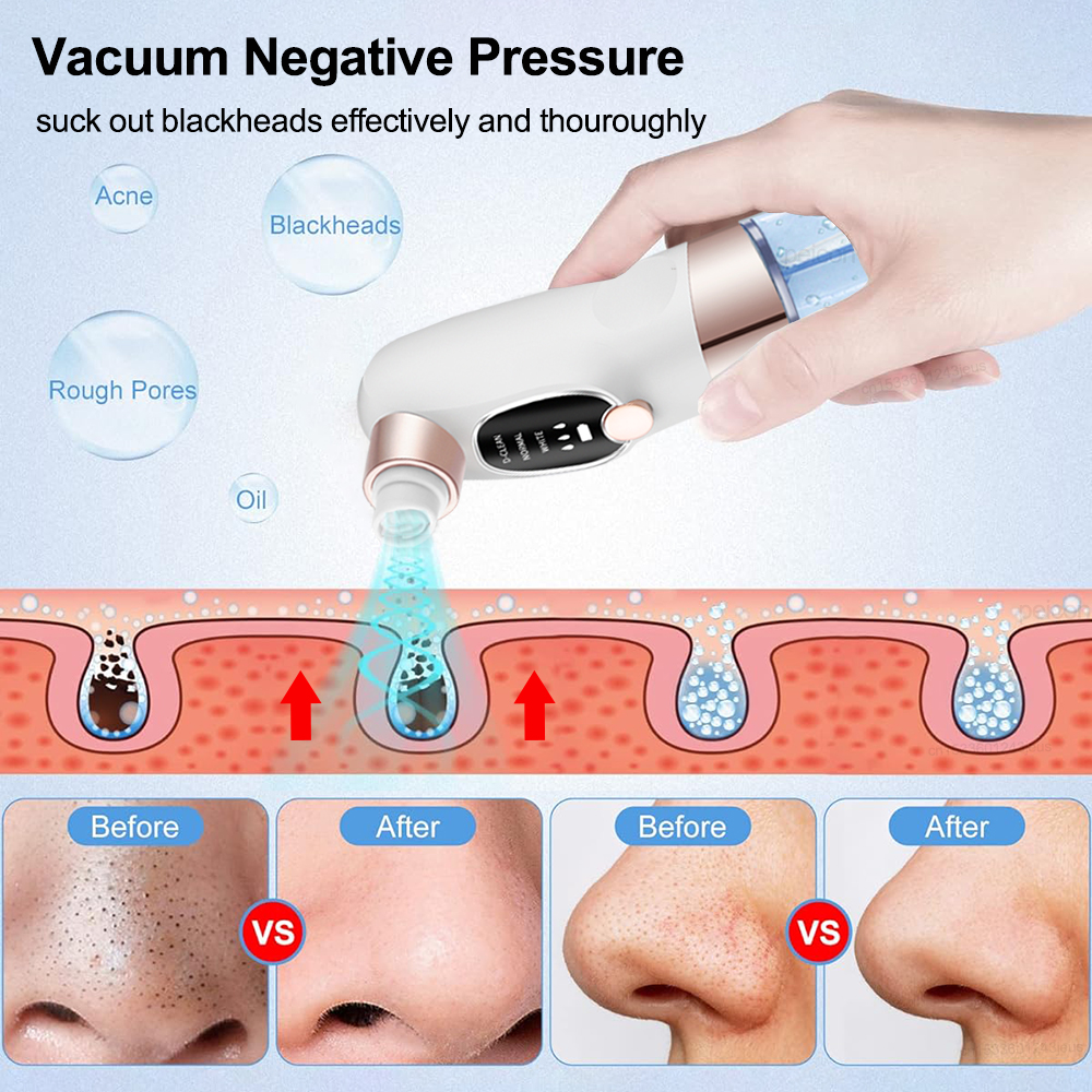 Blackhead Remover Electric Bla – обзор и цена Air Bubble Remover